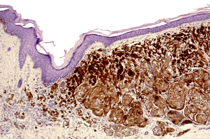 Image: Light micrograph of a section through human skin showing melanoma cancer cells (brown) (Photo courtesy of Steve Gschmeissner / SPL).